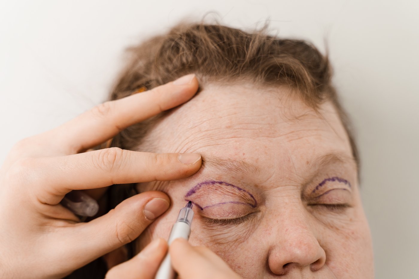 Blefaroplasti - Op. Dr. Emre Yilmazer Yilmazer Clinic